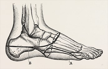 disarticulation of the little toe, medical equipment, surgical instrument, history of medicine