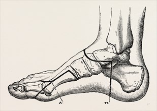 disarticulation of the great toe, medical equipment, surgical instrument, history of medicine