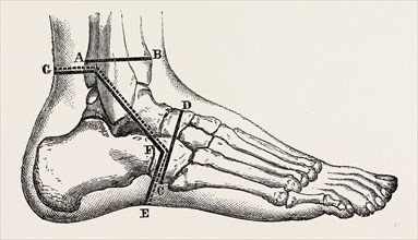 osteo-plastic resection of the foot, medical equipment, surgical instrument, history of medicine