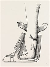 aspect of limb, medical equipment, surgical instrument, history of medicine