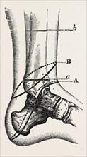 guyon's, medical equipment, surgical instrument, history of medicine