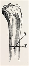 method of  method of sawing, medical equipment, surgical instrument, history of medicine