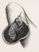 appearance of the stump, medical equipment, surgical instrument, history of medicine