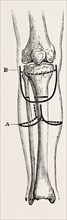 amputation, medical equipment, surgical instrument, history of medicine