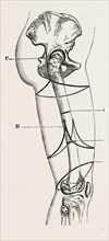 circular amputation of thigh, medical equipment, surgical instrument, history of medicine