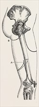 amputation, medical equipment, surgical instrument, history of medicine