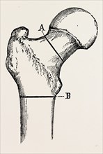 osteotomy, medical equipment, surgical instrument, history of medicine