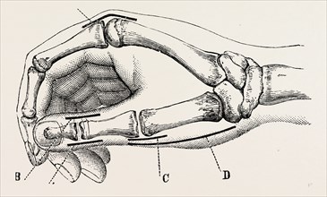 excision of metacarpo-phalangeal joint, medical equipment, surgical instrument, history of medicine