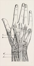 excision of the wrist, medical equipment, surgical instrument, history of medicine