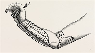 ollieris wire splint for excision of the wrist, medical equipment, surgical instrument, history of