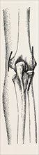 excision the elbow is now extended, medical equipment, surgical instrument, history of medicine