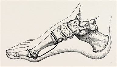 eicision of first metatarsal bone, flap, medical equipment, surgical instrument, history of