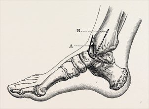 excision of astragalus, inner incision, medical equipment, surgical instrument, history of medicine