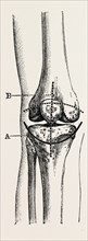 excision of the operation the limb, medical equipment, surgical instrument, history of medicine