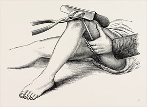 excision of the knee, the sawing of the lower end, medical equipment, surgical instrument, history