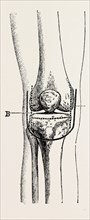 excision, medical equipment, surgical instrument, history of medicine