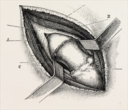 excision of the hip by an external incision, medical equipment, surgical instrument, history of