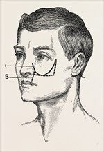 excision of the tipper jaw, medical equipment, surgical instrument, history of medicine