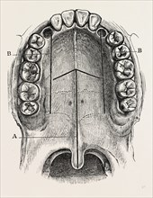 nelaton's operation for nasal polypus, medical equipment, surgical instrument, history of medicine