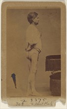 Hugh Wright Civil War victim; Attributed to William H. Bell, American, 1830 - 1910, about 1865; Albumen silver print