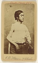 R.B. Mason Pvt. 7 Mich. Excis. head of humerous. Civil War victim; Baldwin & Prior, American, 1865 - 1867, about 1865; Albumen