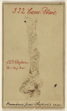 Necrosis of humerus removed Entire with elbow joint by James B. Cutter M.D. Newark, N.J. Patient John E.F. Cleghorn 1st N.J.Cav
