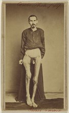 Geo. Ruass. Civil War victim; Attributed to William H. Bell, American, 1830 - 1910, 1862 - 1864; Albumen silver print