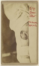 Leg wound of Thomas M. Armstrong, Civil War victim; American; November 2, 1864; Albumen silver print