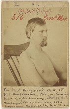 Priv. W.A. Henderson, Civil War vicitim; W. Thompson, American, active 1860s, May 1864; Albumen silver print