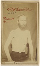 Frances H. V - Civil War victim; W.E. Whitehead, American, active 1860s, 1862 - 1864; Albumen silver print