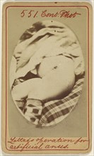 Littre's operation for artificial anus; J.H. Pooley, American, active 1870s - 1880s, December 22, 1871; Albumen silver print