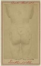 Jno. E. Tucker, shot in the buttocks, Civil War victim; American; 1865 - 1870; Albumen silver print