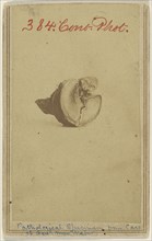 Pathological Specimen from case of Genl. Max Weber. Civil War victim; American; 1862 - 1864; Albumen silver print