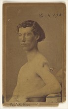 Private Ross Civil War victim; Attributed to William H. Bell, American, 1830 - 1910, 1865-1874; Albumen silver print