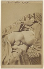 Diseased undescended Testes with Hydwelle; American; 1862 - 1872; Albumen silver print