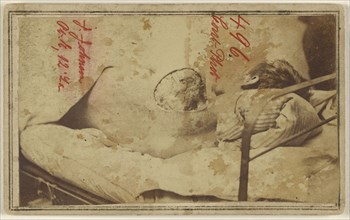 Joseph Johnson, Civil War victim; American; 1864 - 1865; Albumen silver print