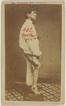 No. 2. Case of John Frederick U.S.V. Side View. Civil War victim; American; 1862 - 1864; Albumen silver print