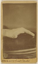 Right hand of Saml. Hagle, wounded at Petersburg June 17th 1864; H.D. Ward, American, active North Adams, Massachusetts 1860s