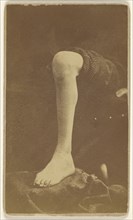 Excision ankle joint Pt. Robert Fuller 45th Ill. Post office Bedford Ohio Civil War victim; J. Dennison, American, active 1860s