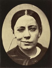 Electro-Physiologie Photographique, Portrait of a Woman, Fig. 35; Guillaume-Benjamin Duchenne, French, 1806 - 1875, 1876