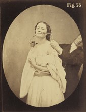 Electro-physiologie Photographique, Fig. 78; Guillaume-Benjamin Duchenne, French, 1806 - 1875, 1876; Albumen silver print
