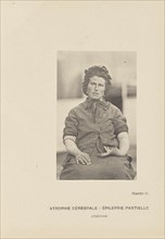 Atrophie Cérébrale: Épilepsie Partielle Athétose; Paul-Marie-Léon Regnard, French, 1850 - 1927, Paris, France; 1878