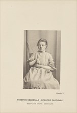Atrophie Cérébrale: Épilepsie Partielle Hémiplégie Droite; Imbécillité; Paul-Marie-Léon Regnard, French, 1850 - 1927, Paris