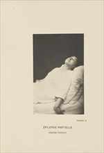 Épilepsie Partielle Période Tonique; Paul-Marie-Léon Regnard, French, 1850 - 1927, Paris, France; 1878; Photogravure