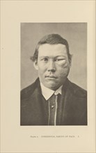 Congenital Nævus of Face; Charles B. Brigham, American, 1845 - 1903, Cambridge, Massachusetts, United States; 1876; Heliotype