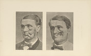 Restoration of Cheek; Charles B. Brigham, American, 1845 - 1903, Cambridge, Massachusetts, United States; 1876; Heliotype