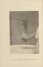 Congenital Fibroma Molluscum; Charles B. Brigham, American, 1845 - 1903, Cambridge, Massachusetts, United States; 1876