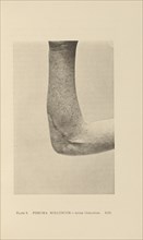 Fibroma Molluscum - After Operation; Charles B. Brigham, American, 1845 - 1903, Cambridge, Massachusetts, United States; 1876