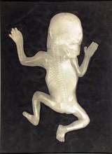 Degree of Ossification of a Five-Month-Old Fetus (Degré d’ossification d’un Foetus de cinq mois),
