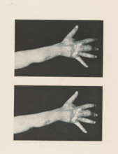 Two views of an arm with symptoms of skin lupus, page, photomechanical print, stereograph,